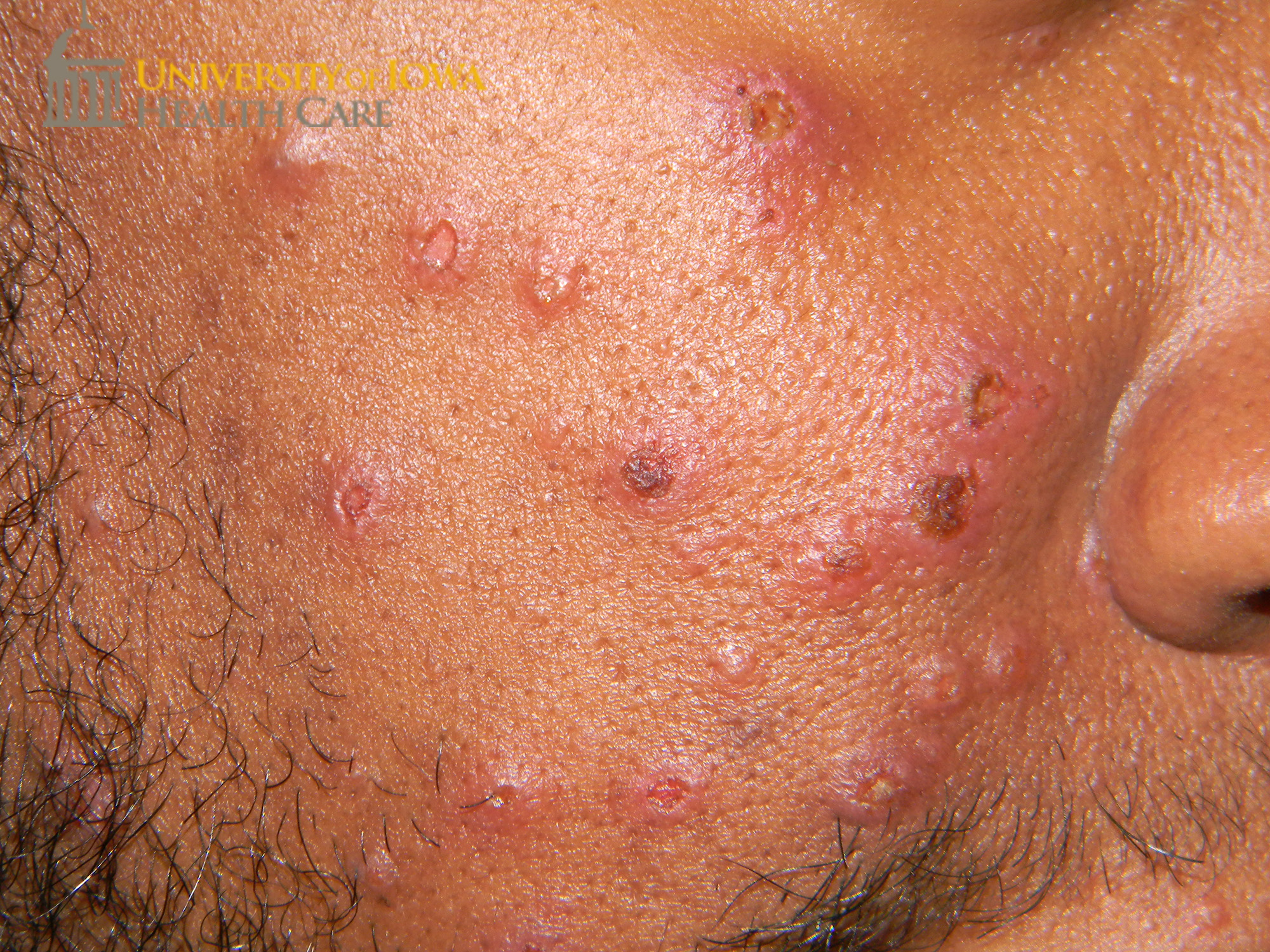 Many cloudy vesicles, some umbilicated and some crusted, on the face. (click images for higher resolution).